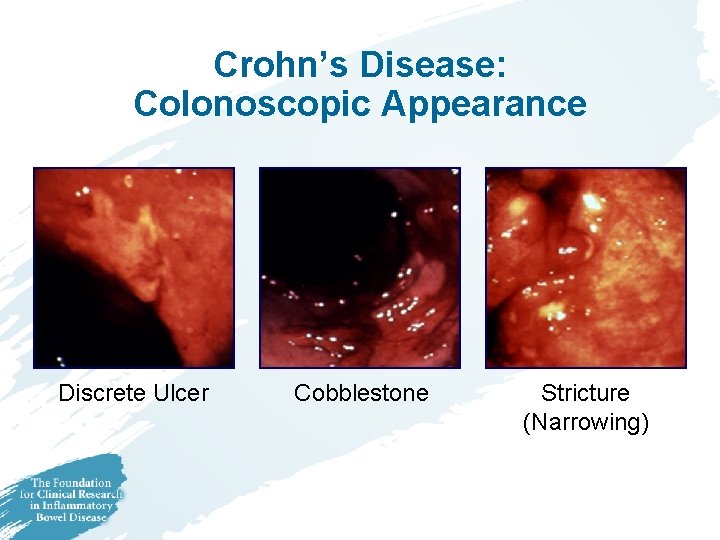 Crohn’s Disease: Colonoscopic Appearance Discrete Ulcer Cobblestone Stricture (Narrowing) 