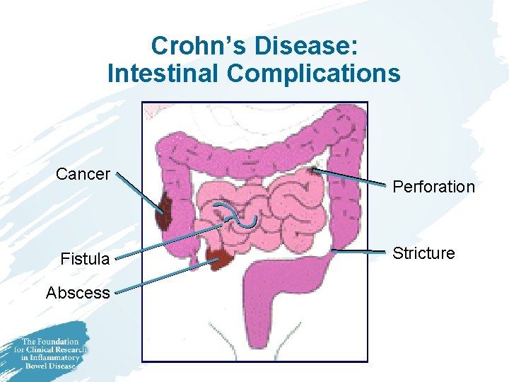 Crohn’s Disease: Intestinal Complications Cancer Fistula Abscess Perforation Stricture 