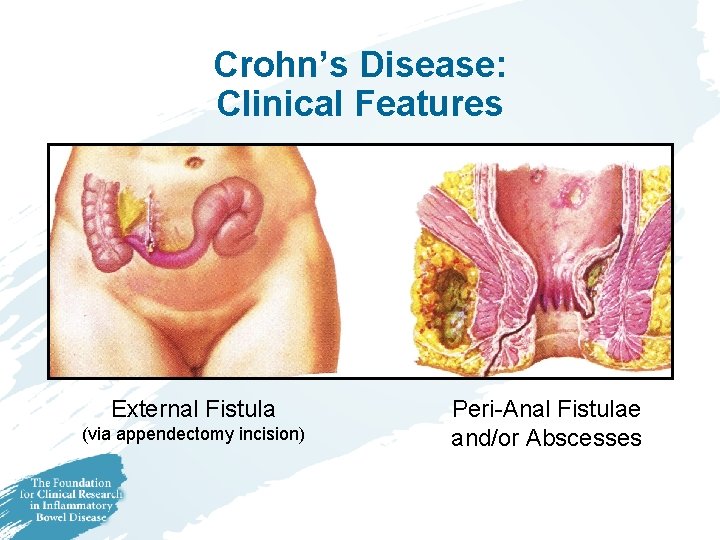 Crohn’s Disease: Clinical Features External Fistula (via appendectomy incision) Peri-Anal Fistulae and/or Abscesses 