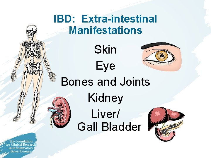 IBD: Extra-intestinal Manifestations Skin Eye Bones and Joints Kidney Liver/ Gall Bladder IBD: Extra-intestinal Manifestations Skin Eye Bones and Joints Kidney Liver/ Gall Bladder