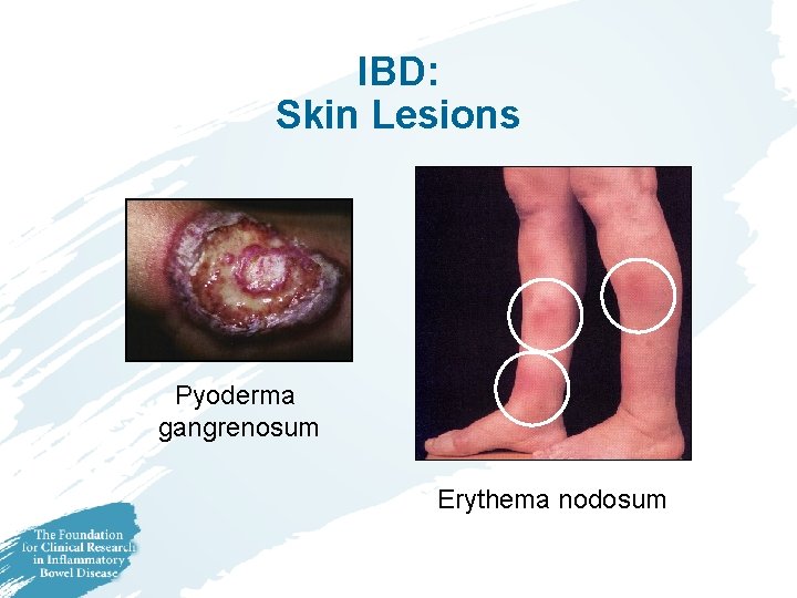 IBD: Skin Lesions Pyoderma gangrenosum Erythema nodosum IBD: Skin Lesions Pyoderma gangrenosum Erythema nodosum
