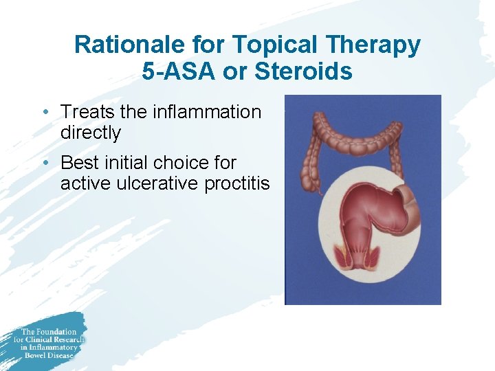 Rationale for Topical Therapy 5 -ASA or Steroids • Treats the inflammation directly • Rationale for Topical Therapy 5 -ASA or Steroids • Treats the inflammation directly •