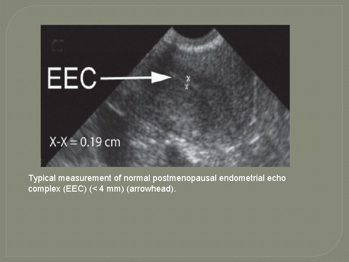 Typical measurement of normal postmenopausal endometrial echo complex (EEC) (< 4 mm) (arrowhead). 