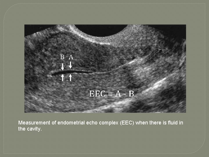 Measurement of endometrial echo complex (EEC) when there is fluid in the cavity. 