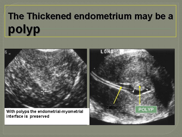 The Thickened endometrium may be a polyp With polyps the endometrial-myometrial interface is preserved