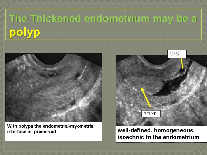 The Thickened endometrium may be a polyp CYST POLYP With polyps the endometrial-myometrial interface