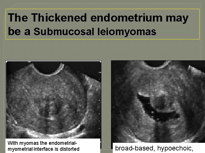 The Thickened endometrium may be a Submucosal leiomyomas With myomas the endometrialmyometrial interface is
