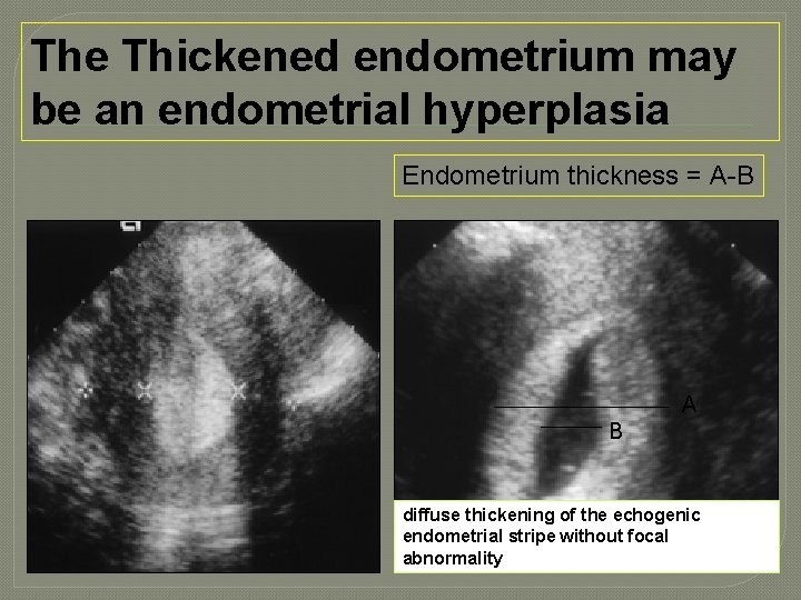 The Thickened endometrium may be an endometrial hyperplasia Endometrium thickness = A-B A B