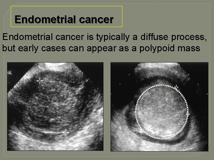 Endometrial cancer is typically a diffuse process, but early cases can appear as a