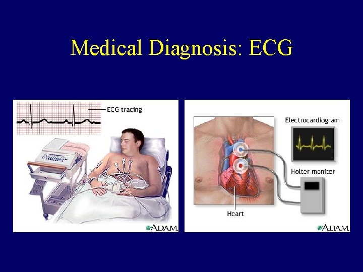 Medical Diagnosis: ECG 