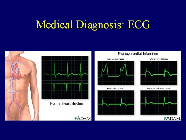 Medical Diagnosis: ECG 