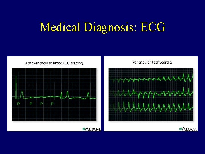 Medical Diagnosis: ECG 