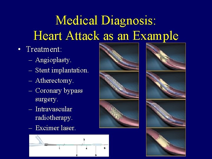 Medical Diagnosis: Heart Attack as an Example • Treatment: – – Angioplasty. Stent implantation.