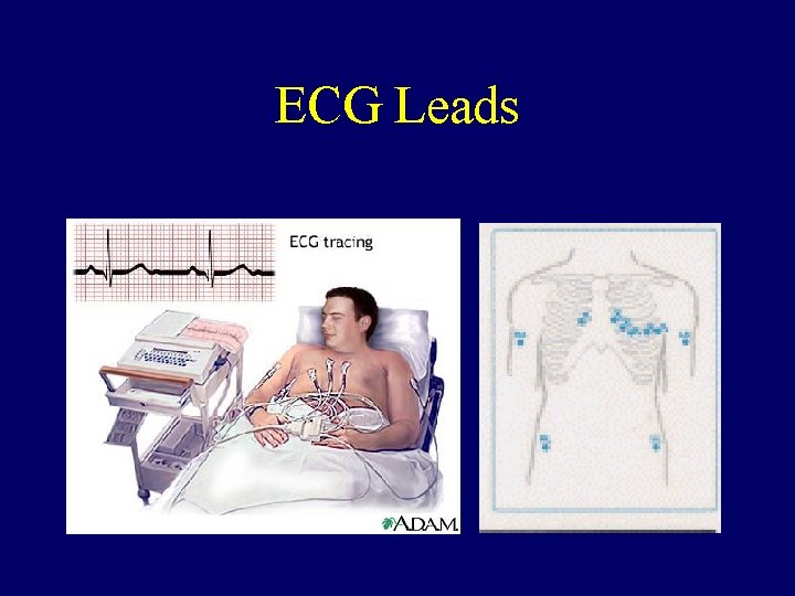 ECG Leads 