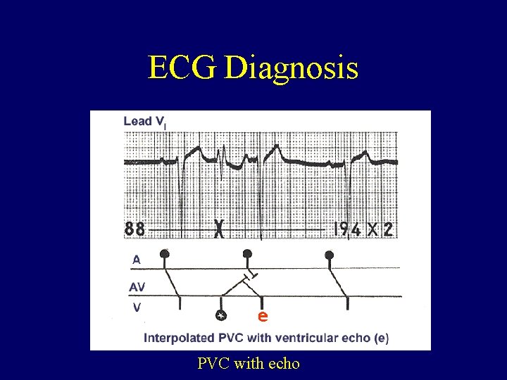 ECG Diagnosis PVC with echo 