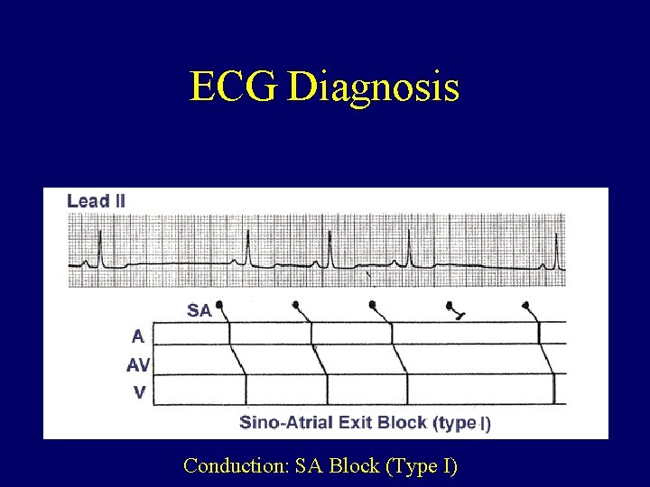 ECG Diagnosis Conduction: SA Block (Type I) 