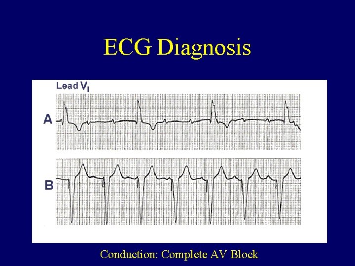ECG Diagnosis Conduction: Complete AV Block 