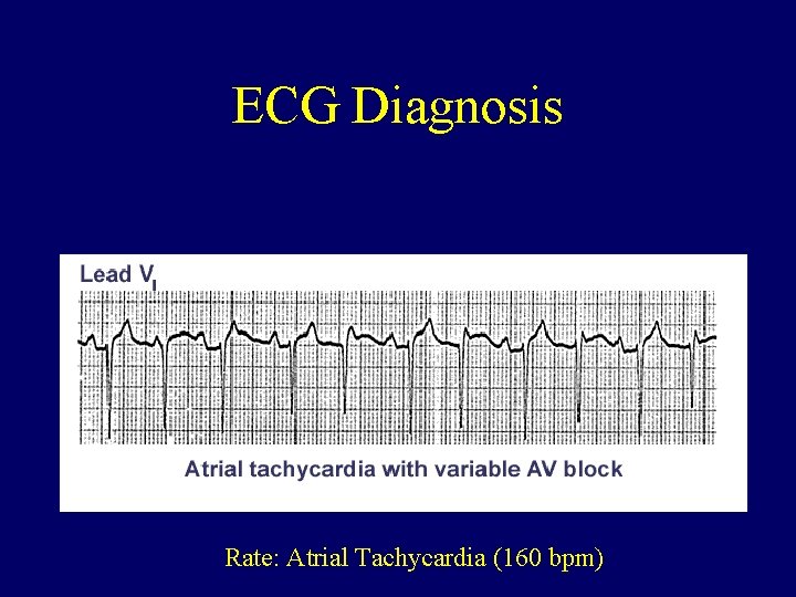 ECG Diagnosis Rate: Atrial Tachycardia (160 bpm) 