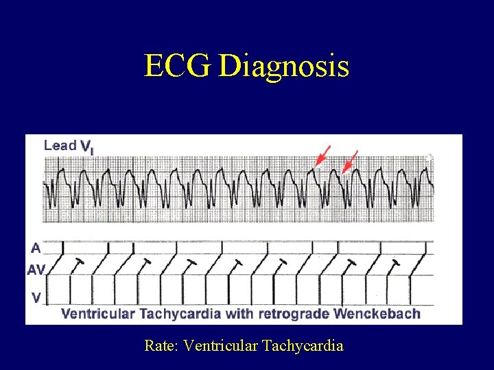 ECG Diagnosis Rate: Ventricular Tachycardia 