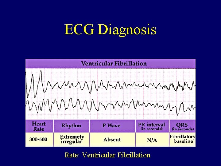 ECG Diagnosis Rate: Ventricular Fibrillation 