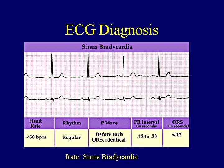 ECG Diagnosis Rate: Sinus Bradycardia 