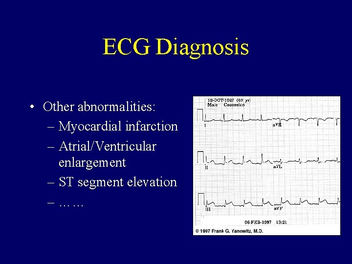 ECG Diagnosis • Other abnormalities: – Myocardial infarction – Atrial/Ventricular enlargement – ST segment