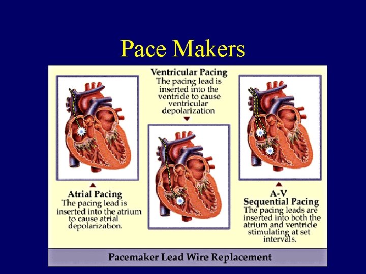 Pace Makers 