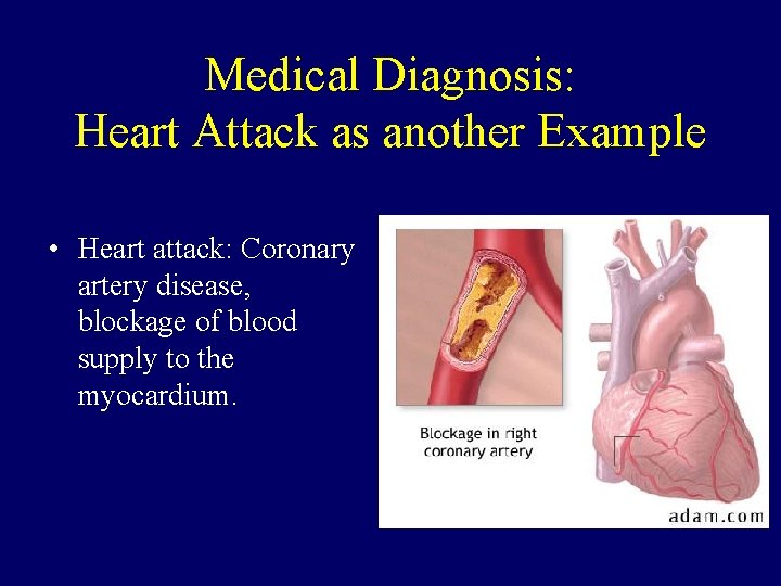 Medical Diagnosis: Heart Attack as another Example • Heart attack: Coronary artery disease, blockage