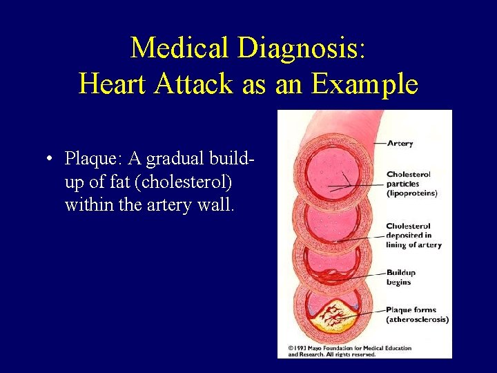 Medical Diagnosis: Heart Attack as an Example • Plaque: A gradual buildup of fat