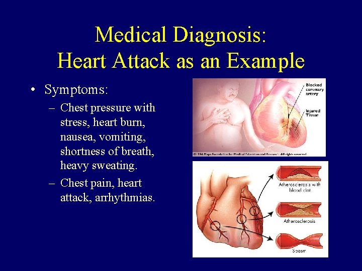 Medical Diagnosis: Heart Attack as an Example • Symptoms: – Chest pressure with stress,