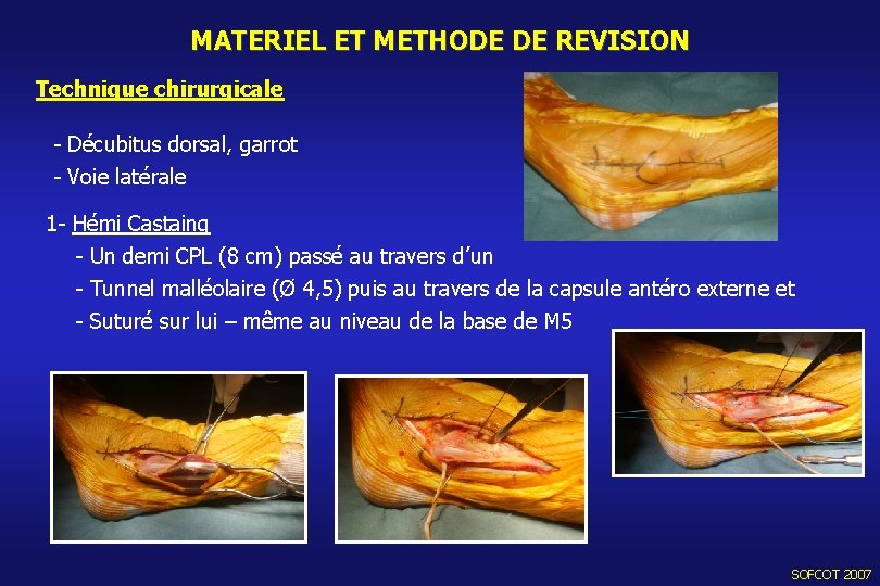 MATERIEL ET METHODE DE REVISION Technique chirurgicale - Décubitus dorsal, garrot - Voie latérale