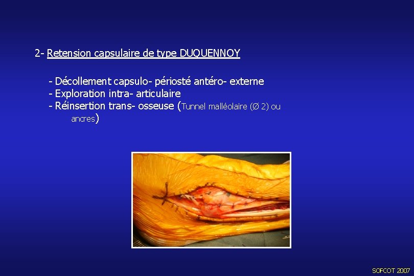 2 - Retension capsulaire de type DUQUENNOY - Décollement capsulo- périosté antéro- externe -