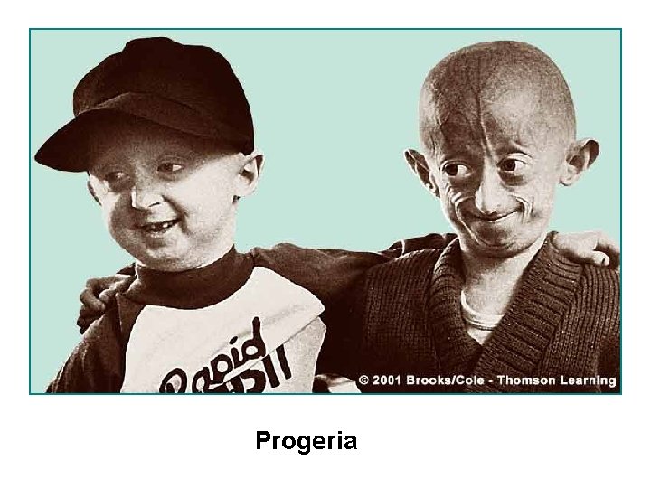 Progeria 