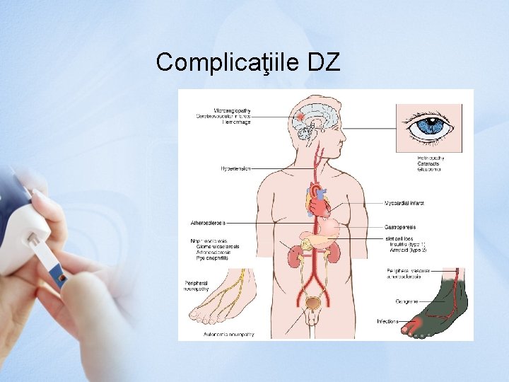 Complicaţiile DZ 