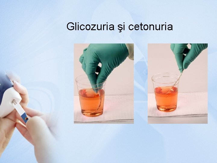 Glicozuria şi cetonuria 