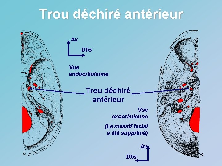 Trou déchiré antérieur Av Dhs Vue endocrânienne Trou déchiré antérieur Vue exocrânienne (Le massif