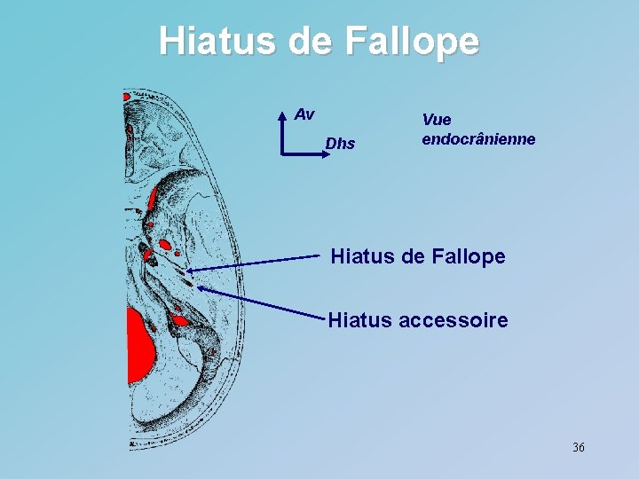Hiatus de Fallope Av Dhs Vue endocrânienne Hiatus de Fallope Hiatus accessoire 36 
