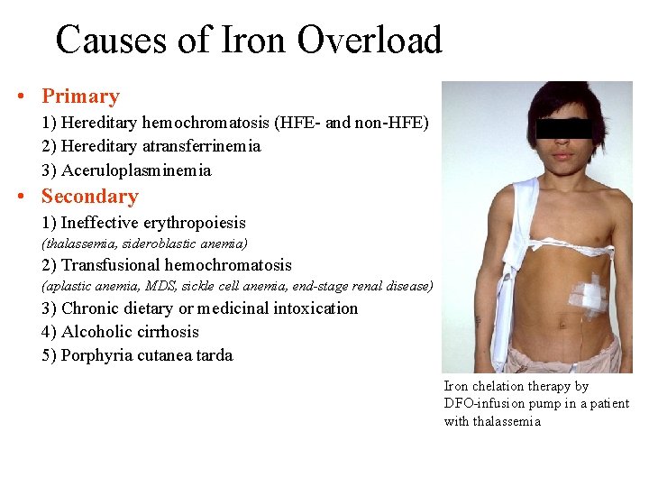 Causes of Iron Overload • Primary 1) Hereditary hemochromatosis (HFE- and non-HFE) 2) Hereditary