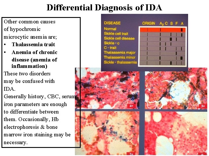 Differential Diagnosis of IDA Other common causes of hypochromic microcytic anemia are; • Thalassemia