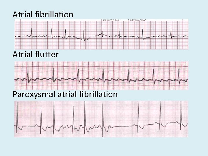 Atrial fibrillation Atrial flutter Paroxysmal atrial fibrillation 