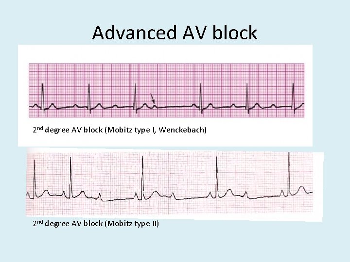 Advanced AV block 2 nd degree AV block (Mobitz type I, Wenckebach) 2 nd