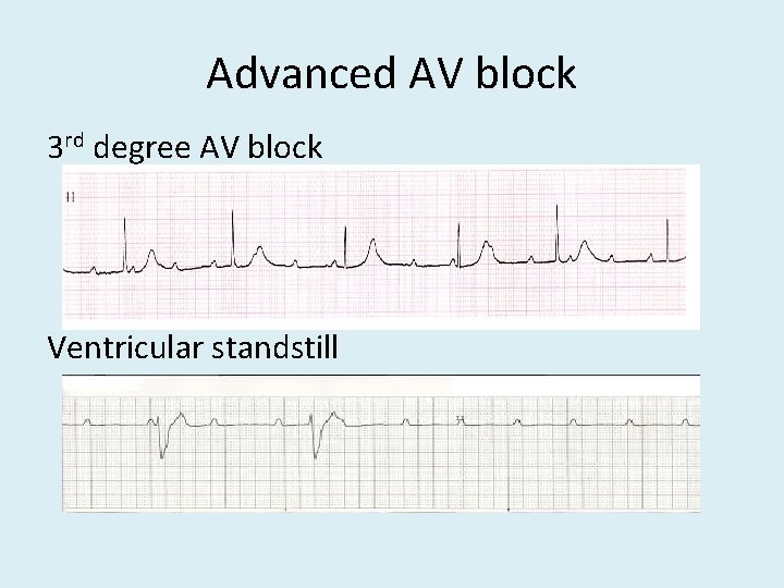 Advanced AV block 3 rd degree AV block Ventricular standstill 