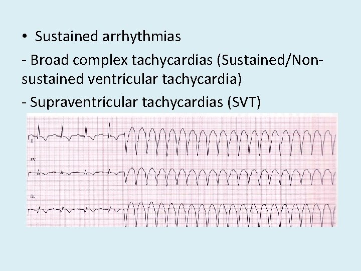  • Sustained arrhythmias - Broad complex tachycardias (Sustained/Nonsustained ventricular tachycardia) - Supraventricular tachycardias