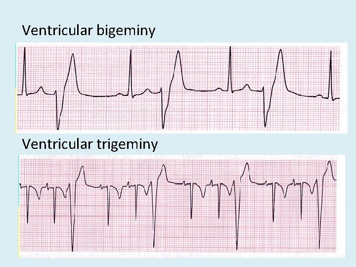 Ventricular bigeminy Ventricular trigeminy 