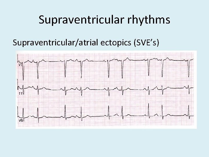 Supraventricular rhythms Supraventricular/atrial ectopics (SVE’s) 