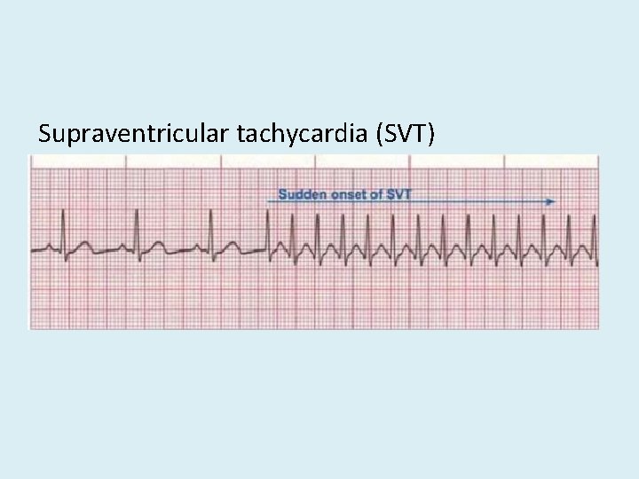 Supraventricular tachycardia (SVT) 