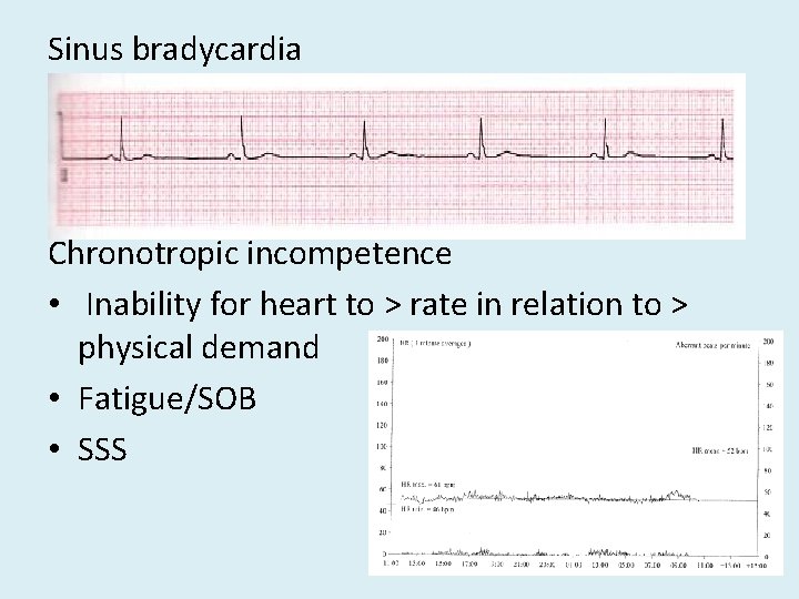 Sinus bradycardia Chronotropic incompetence • Inability for heart to > rate in relation to