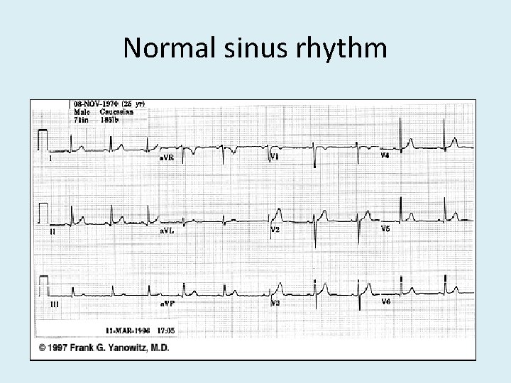 Normal sinus rhythm 