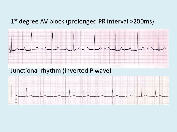 1 st degree AV block (prolonged PR interval >200 ms) Junctional rhythm (inverted P