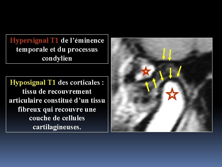 Hypersignal T 1 de l’éminence temporale et du processus condylien Hyposignal T 1 des